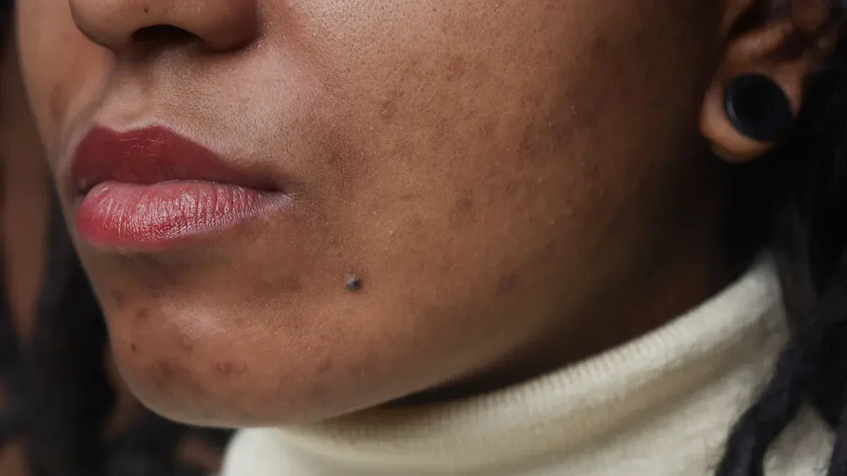 Acné sur peau noire : boutons, taches post-acné et routine adaptée Imagen