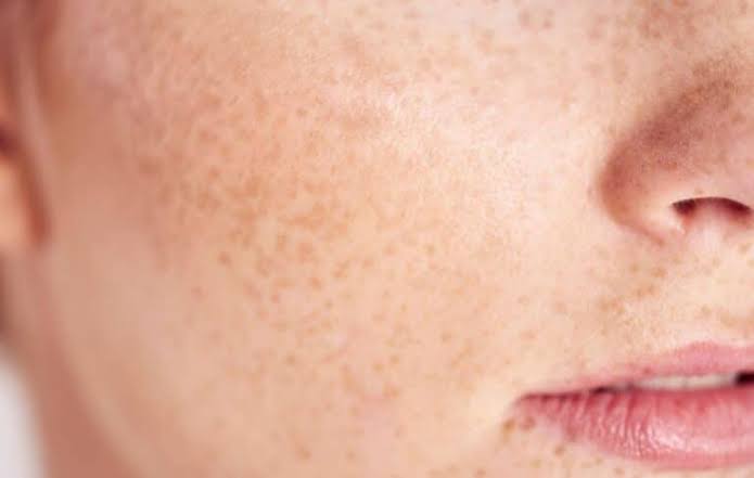 Taches après les boutons ou cicatrices d’acné : comment les différencier ? Imagen