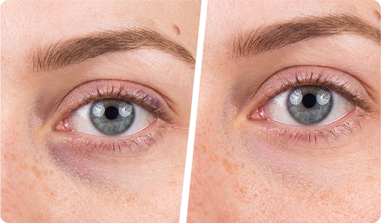 Patch yeux réutilisable ou à usage unique : lequel choisir ? Imagen