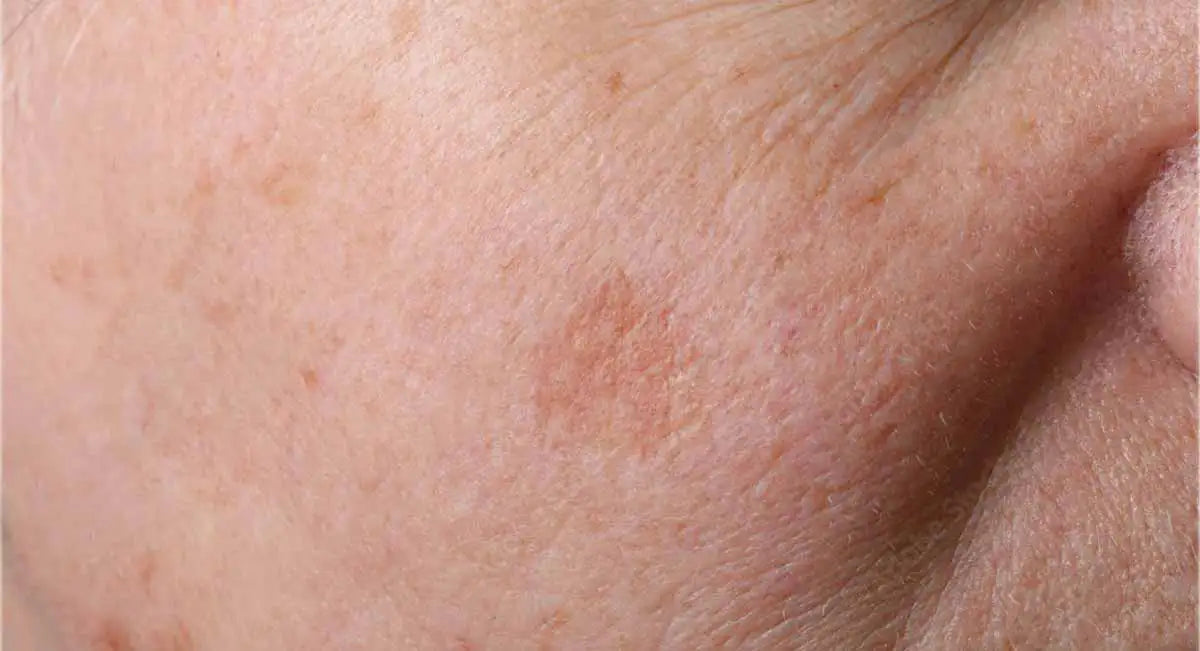 Acide kojique ou curcuma : quel actif choisir contre les taches brunes Imagen